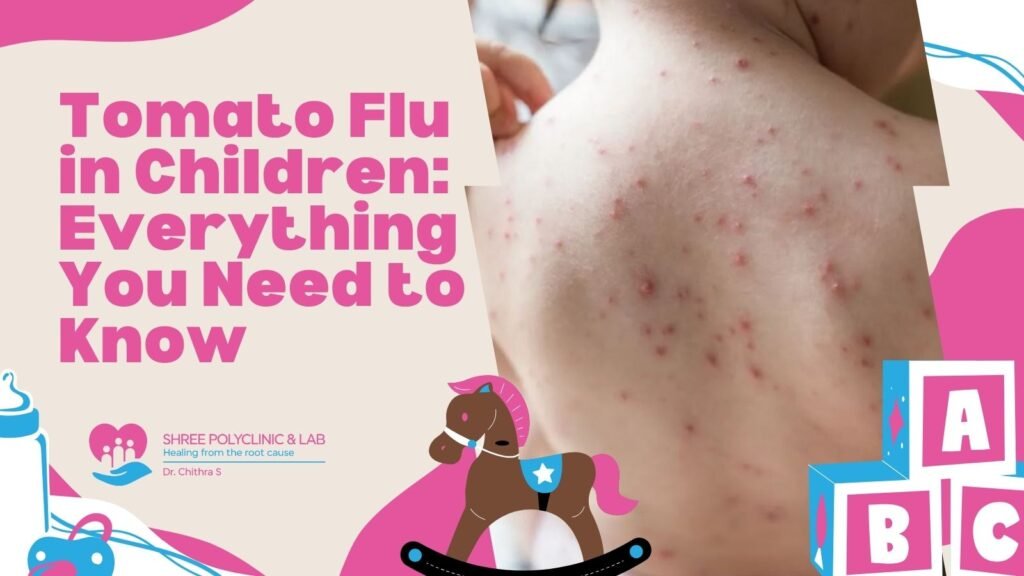 Tomato Flu in Children Everything You Need to Know